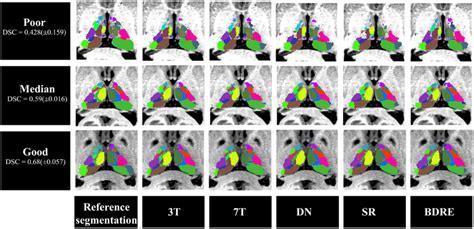 Registration Based Image Enhancement Improves Multi Atlas Segmentation