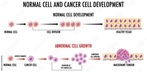 Diagram showing normal and cancer cells Stock Vector | Adobe Stock