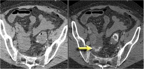 The Radiology Assistant Ct Contrast Injection And Protocols Pulmonary Emboli Acute