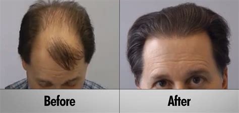 Understanding Hair Transplant Costs