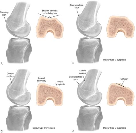 Trochleoplasty Clinical Tree