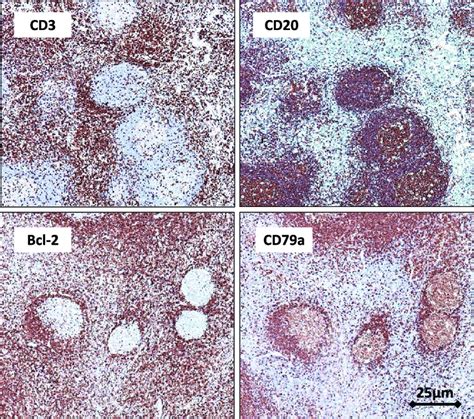 Immunohistochemical Analysis Of The Tumor Cd Positive Cells Are