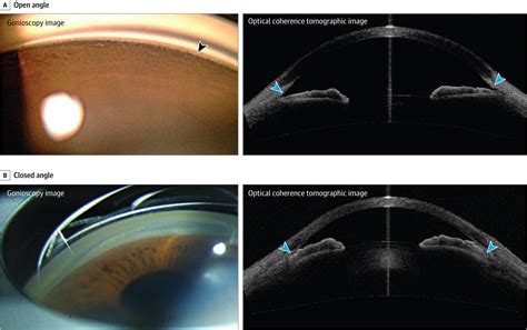 Pathophysiology And Treatment Of Glaucoma Genetics And Genomics