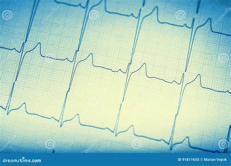 De Grafiek Van Ekg Elektrocardiogram Ekg Ecg Stock Afbeelding Image