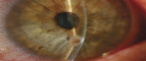 Perforated Corneal Ulcer With Subsequent Endophthalmitis In Cornea