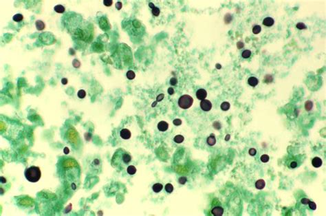 Fungus - Cryptococcosis | Perri Dermatology