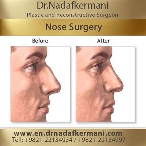 Rhinoplasty | nose surgery | Rhinoplasty Surgery