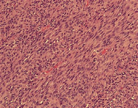 Histopathology Of The Tumor A B The Tumor Composed Of Spindle Cells