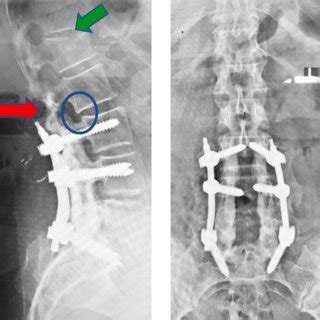 Xlif Lumbar Spinal Fusion