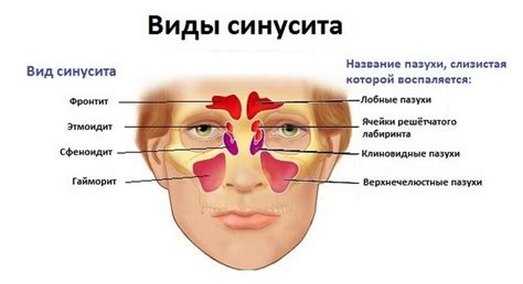 Синусит у детей: симптомы и лечение, как и чем лечить