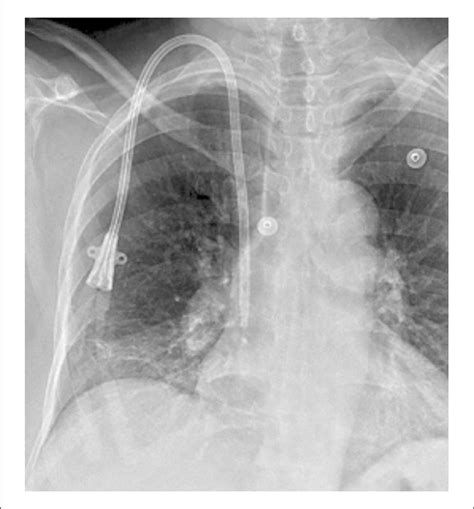 Radiograph Of A Right Internal Jugular Tunneled Central Venous Catheter