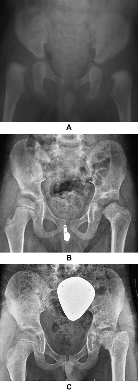 A Preoperative X Ray Male Patient Was Operated On At 5 Months Of Download Scientific Diagram