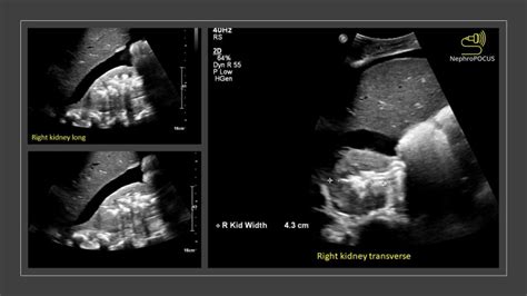 Prominent renal vascular calcifications – NephroPOCUS