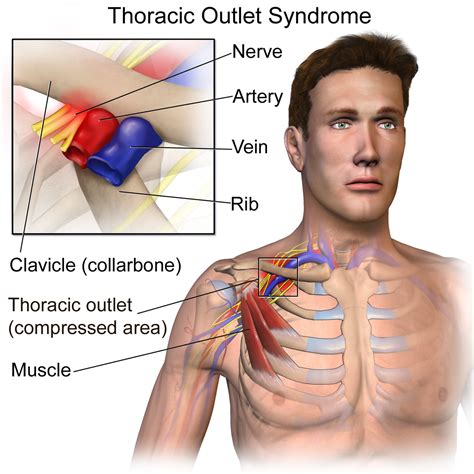 Anatomy Of The Thoracic Outlet And The Thoracic Outlet Syndrome