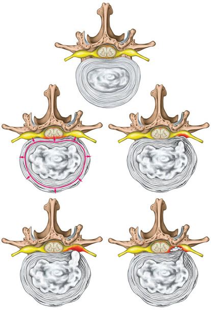 Mamillary Process Free Stock Photos Images And Pictures Of Mamillary