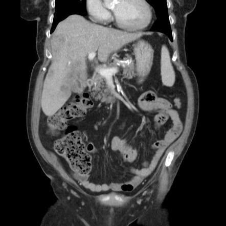 Gallbladder Adenocarcinoma Radiology Case Radiopaedia Org