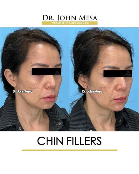 Chin Filler Before And After Photos Dr Mesa