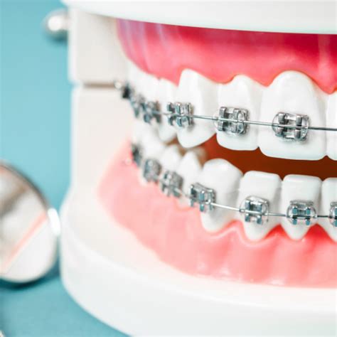 Orthodontie Enfant Appareil Dentaire Pour Enfant Denteka