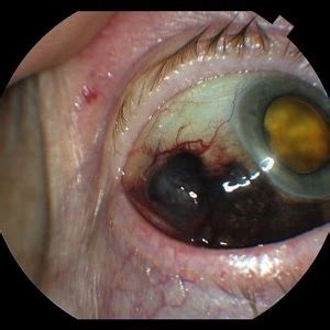 Extrascleral Extension Of Choroidal Melanoma Retina Image Bank