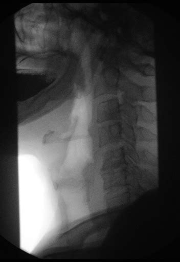 Esophageal Ulcer Barium