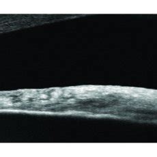 Lisch nodules in neurofibromatosis type 1. Slit lamp (A, B) and... | Download Scientific Diagram