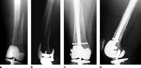 Anteroposterior A And Lateral B Radiographs Of A Periprosthetic Download Scientific