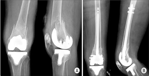 Figure 2 From Periprosthetic Fracture Following Total Knee Arthroplasty Review Article