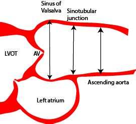 Aortopathy - Aortic root dilatation - Critical Care Sonography