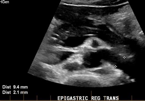 Nutcracker Syndrome On Ultrasound R Radiology