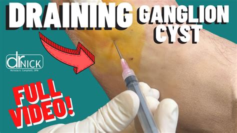 Draining A Ganglion Cyst Dr Nick Campitelli Youtube