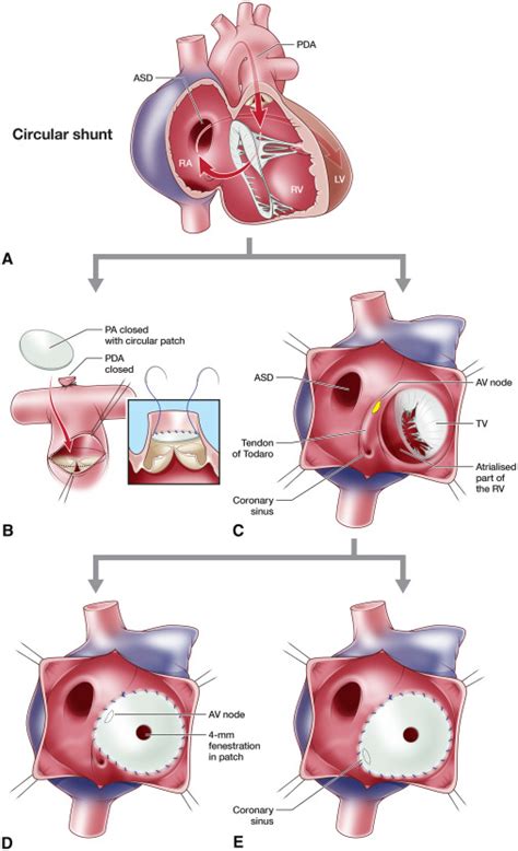 The American Association For Thoracic Surgery AATS 2024 Expert