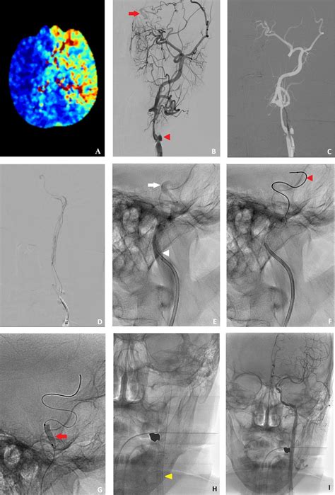 Elsevier Radiology On Twitter Chronic Occlusion Of The Internal