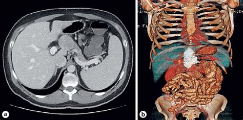 Computed Tomography Image A And 3d Reconstruction B Revealing Download Scientific