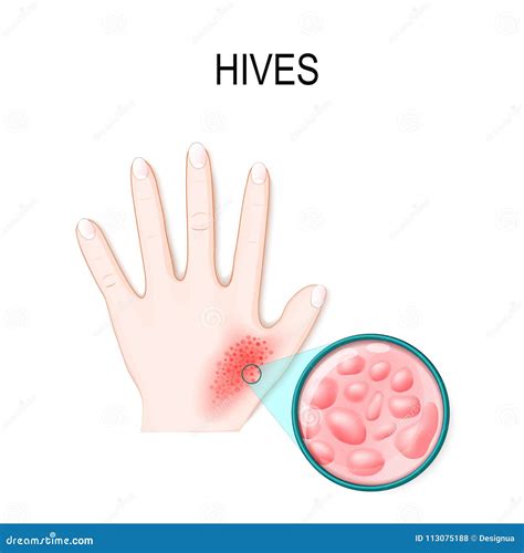 Skin Rash Hives Or Urticaria Stock Vector Illustration Of Eruption