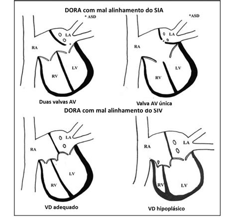 Trabalho De Conclusão De Curso Dupla Via De Saída Do Átrio Direito