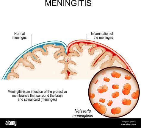 La Meningitis Es Una Infecci N De Las Membranas Protectoras Que Rodean