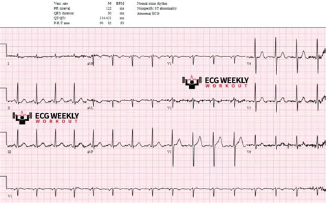 ECG Basics and Fundamentals: the earliest evidence of cardiac ischemia ...