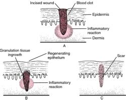 Soft Tissue Healing - Physiopedia