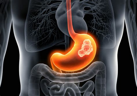 Zolbetuximab Plus Chemo Deemed New Standard Care For Gastric GEJ Cancer