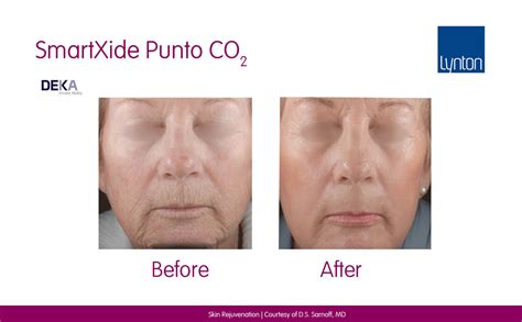 Smartxide Punto • Skin Resurfacing Co2 Laser • Lynton Lasers