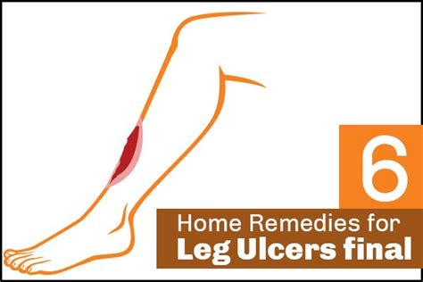 6 Effective Home Remedies For Leg Ulcers Leg Ulcers Feet Care Ulcers