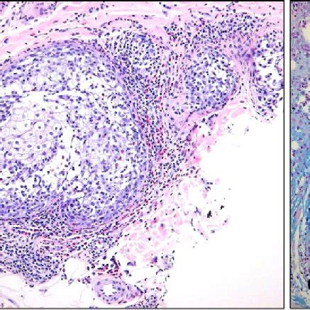 (A) Degeneration of the pilosebaceous unit with formation of cystic ...