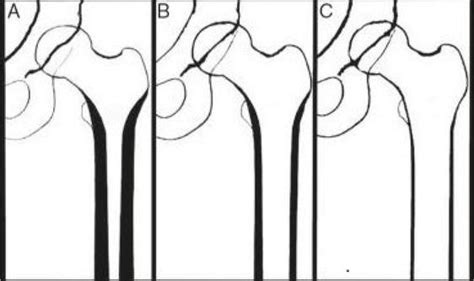 Classifications Used In Total Hip Arthroplasty Intechopen