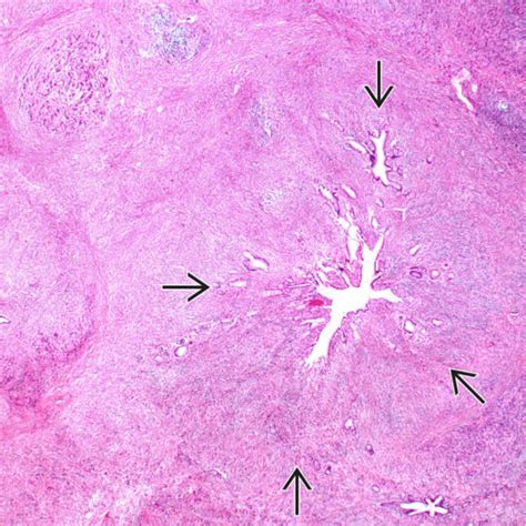 Autoimmune Pancreatitis Basicmedical Key