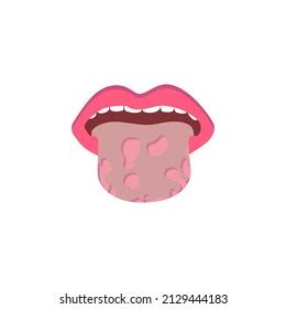 Glossitis Oral Thrush Candidiasis On Tongue Stock Vector (Royalty Free ...