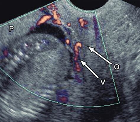 Vasa Previa Transvaginal Power Doppler Us Image Obtained At 18 Weeks Download Scientific