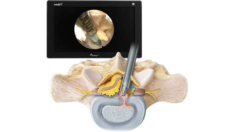 Arthrex Spine