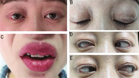 Bilateral Blepharochalasis A B Double Lip C And Pseudoappearance Download Scientific