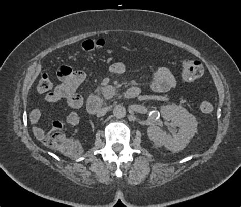 Recurrent Renal Cell Carcinoma With Pancreas Adrenal And Liver