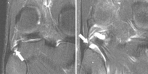 Popliteofibular Ligament Mri